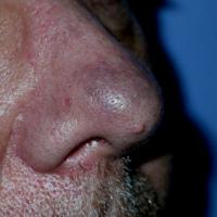 
	Minocycline pigmentation of the nose