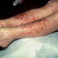 
	Cutaneous vasculitis 
