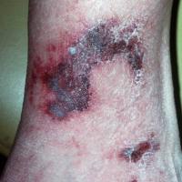 
	Leucocytoclastic vasculitis causing more…