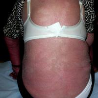 
	Erythroderma 
