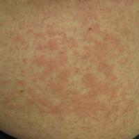 
	Urticaria
