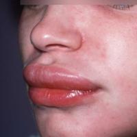 
	Angioedema
