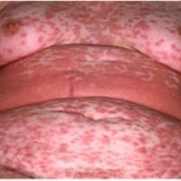 
	Drug Hypersensitivity syndrome