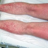 
	Drug Hypersensitivity syndrome caused by…