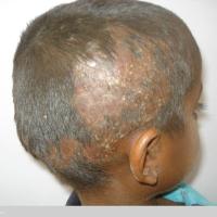 
	Tinea capitis and scarring
