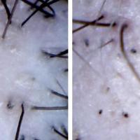 
	Dermoscopic appearance of…
