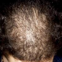 
	Female pattern alopecia

	Copied with kind…