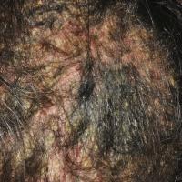 
	Pemphigus vulgaris

	Copied with kind…