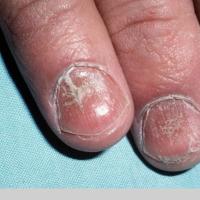
	Alopecia areata - nail pitting and dystrophy