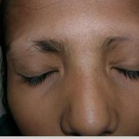 
	Alopecia areata affecting the eyebrows