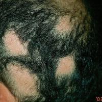 
	Alopecia areata

	Copied with kind permission…