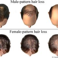 
	Male and female pattern alopecia 