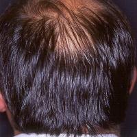 
	Male pattern alopecia

	Copied with kind…