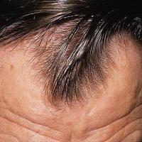 
	Male pattern alopecia