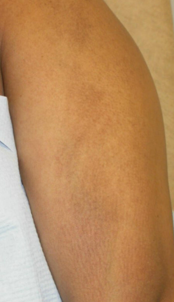 Amyloidosis