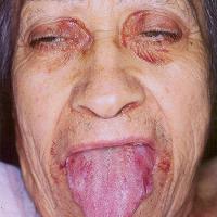 
	Systemic amyloidosis and glossitis

	Copied…