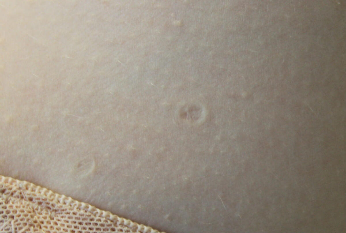 Anetoderma