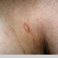 Anetoderma