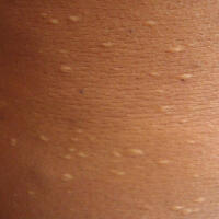 Anetoderma