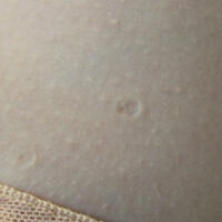 Anetoderma Face Anetoderma