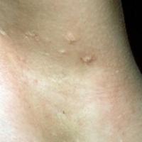 
	Anetoderma 
