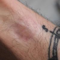 Anetoderma