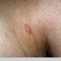 
	Anetoderma 