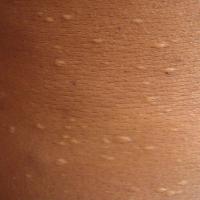 
	Anetoderma secondary to pancreatitis 