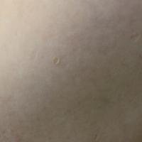 
	Anetoderma 