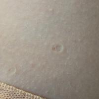 
	Anetoderma