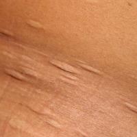 
	Anetoderma