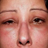
	Angioedema

	Copied with kind permission from…