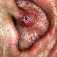 
	Angiolymphoid hyperplasia