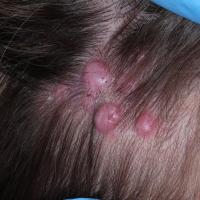 Angiolymphoid hyperplasiaCopied with kind…