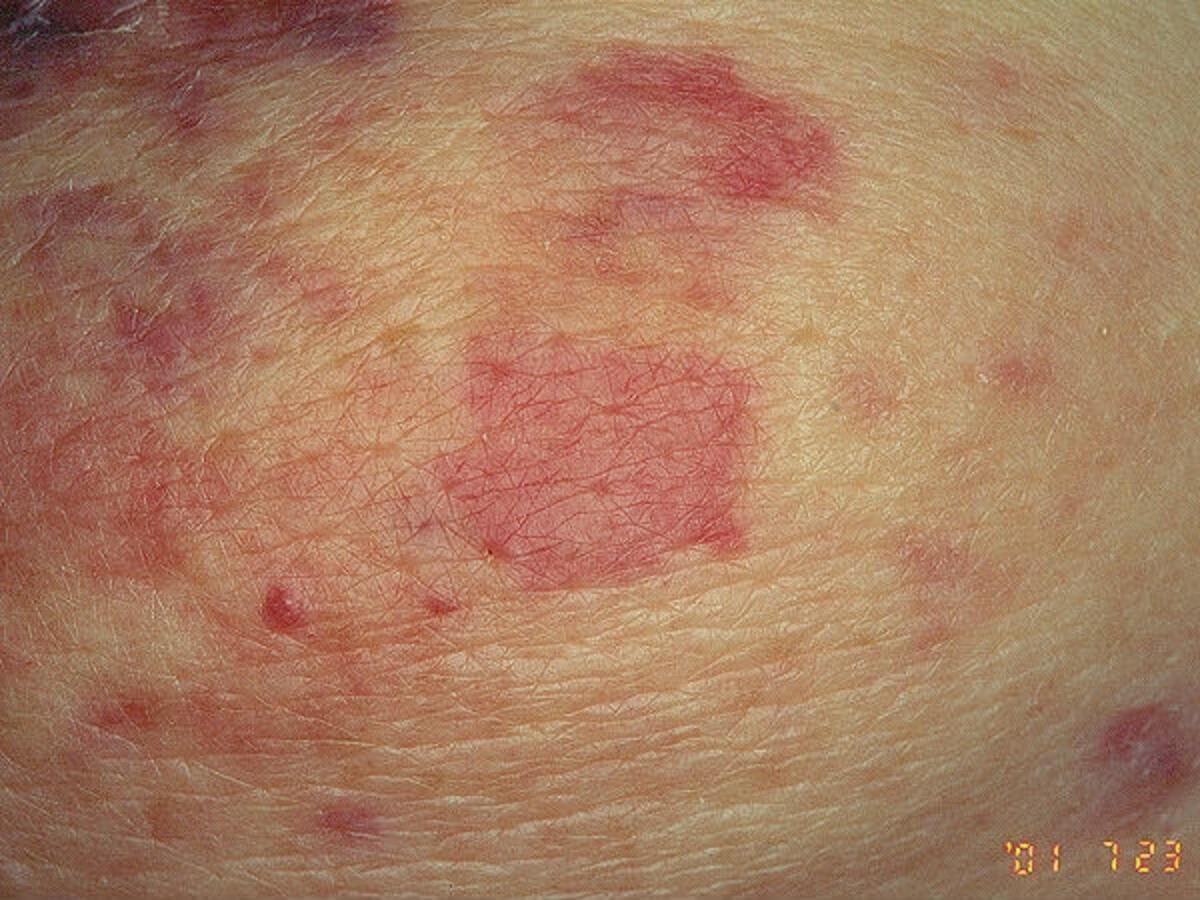 Angiosarcoma Of The Spine – Angiosarcoma: clinical and imaging features ...
