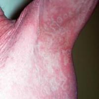 Erythema gyratum repens
Same patient as previous…