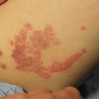 
	A deep gyrate erythema 

	This probably…