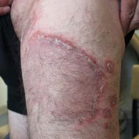 
	Erythema annulare centrifugum

	A 15-year…
