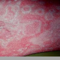 
	Erythema gyratum repens
