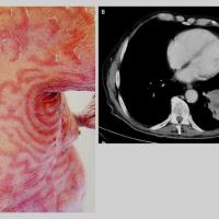 Erythema gyratum repens secondary to bronchial…
