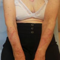 
	Subacute cutaneous lupus erythematosus