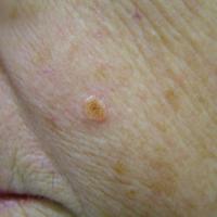 
	Sebaceous adenoma
