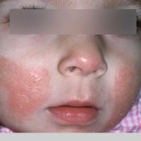 
	Atopic eczema