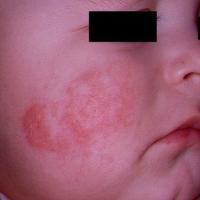 
	Atopic eczema
	
	Ill-defined erythema

	Copied…