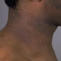 
	Atopic eczema&nbsp;
