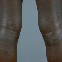 
	Atopic eczema