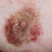 
	Atopic eczema - lichenified and infected eczema…