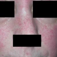 
	Atopic eczema - steroid atrophy

	The atrophy…
