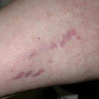 
	Atopic eczema and steroid related striae&nbsp;