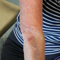 
	Atopic eczema
	
	Steroid related skin atrophy…